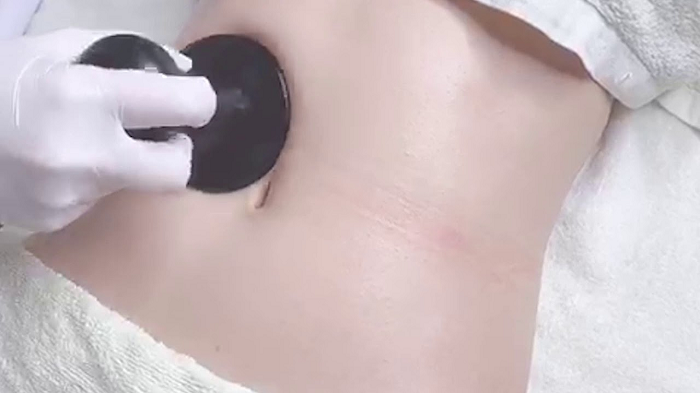 Công Nghệ Giảm Béo RF Là gì ? Nguyên lý hoạt động và ứng dụng 1 Công Nghệ Giảm Béo RF